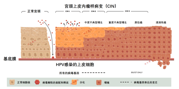 宮頸癌是怎樣一步步形成的？